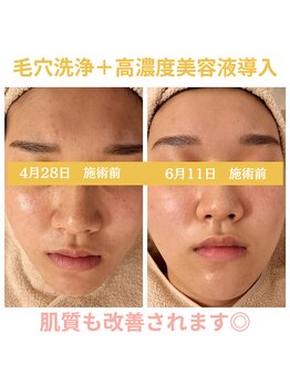 エリン(ERIN)/毛穴徹底洗浄