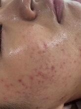 ピュアージュ/ハーブピーリング