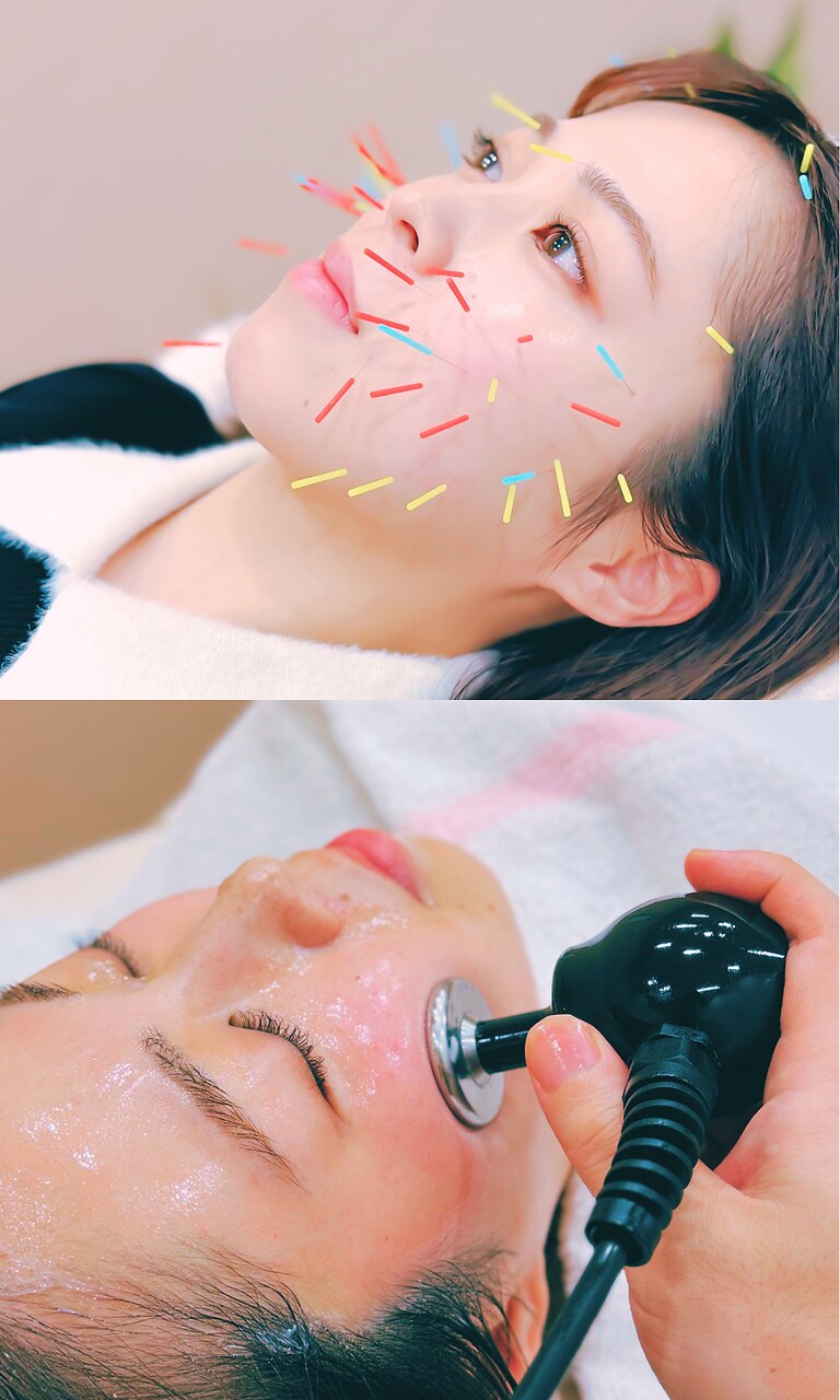 ＊人気No.1＊【小顔/トーンUP】美容鍼64本+ダブルパルス&高周波(RF)