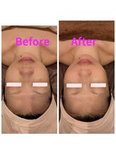 ハナノ つきのわ店(Hanano)/剥離なし肌育ピーリング