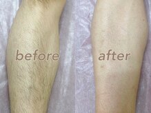 フルーブラン(Frubran)/【メンズ脱毛】45分打ち放題