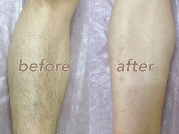 フルーブラン(Frubran)/【メンズ脱毛】45分打ち放題