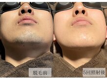 メンズアルファ/【髭】光脱毛before after 20代