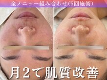 アポシェ(apoche)/肌質改善/肌荒れ/赤み/毛穴