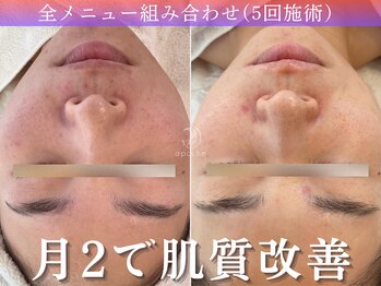 アポシェ(apoche)/肌質改善/肌荒れ/赤み/毛穴