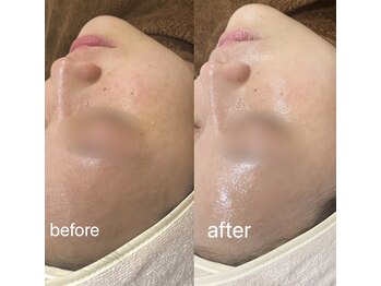 ベルエサロン(Belle Salon)/ハイドラ×アンストレス