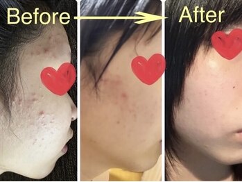 ヨサパーク ミモザ 三軒茶屋店(YOSA PARK Mimosa)/艶プル美肌×小顔×毛穴レス改善