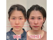 小顔22 ボルティ 赤坂支店(Bolty)/30代：小顔シンメトリー（20回）