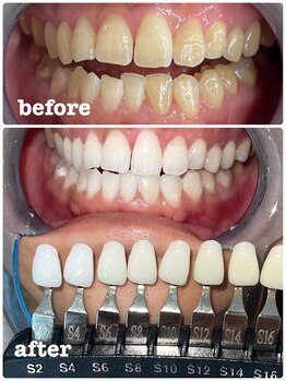 エクシア ホワイトニング 富山店/ビフォーアフター写真☆