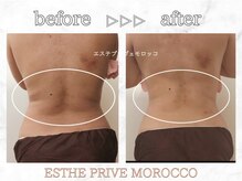 エステプリヴェモロッコ(ESTHE PRIVE MOROCCO)/スライドカッピング+キャビラジ
