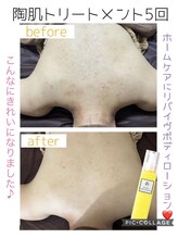 サロンデュヒャーク 志木駅前店(salon du ひゃーく)/ボディの陶肌トリートメント痩身