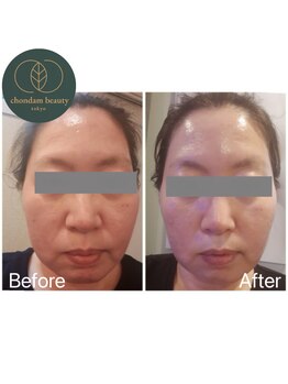 チョンダムビューティー(chondam beauty)/たるみケア&水光ケアでツヤ美肌