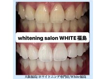 ホワイトニングサロン ホワイト(WHITE)/セルフホワイトニング/大阪/福島