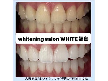 ホワイトニングサロン ホワイト(WHITE)/セルフホワイトニング/大阪/福島