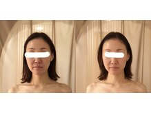 ニューミー スパ(newme spa)/小顔矯正。