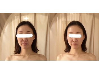 ニューミー スパ(newme spa)/小顔矯正。