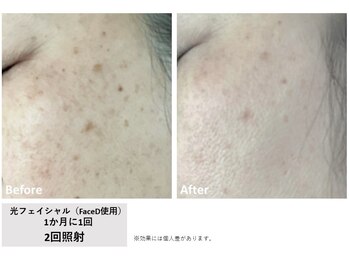 メイ(meiy)/しみ/美白/毛穴/フェイシャル