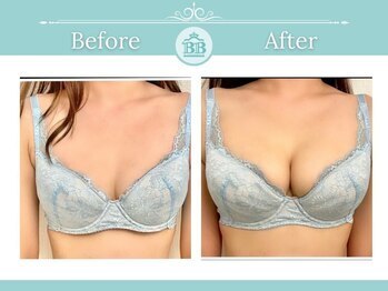 美人バスト 宇都宮店/★バストアップ症例/育乳★