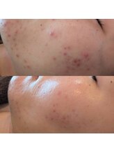 ラリュール(L'Allure)/ハーブピーリング