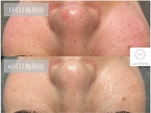 ラヴィオーラ 西宮北口店(La Viora)/ダイヤモンドハーブピーリング