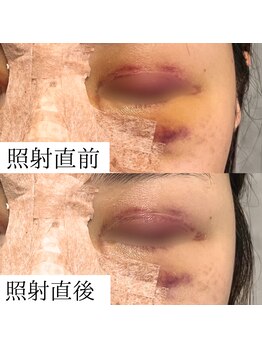 ヒカリエステ 六本木(HIKARI ESTHE)/腫れや痛みの短縮に