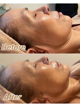 アレッタ 相模原/耳横のたるみ改善