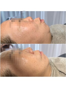 シェリール(cherir)/フェイスラインにアプローチ！