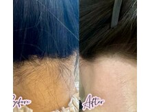 アピール(Appeal)/うなじWAX脱毛