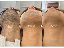 シャイニー/脱毛経過　初回/１０回/２５回