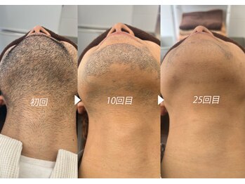 シャイニー/脱毛経過 初回/10回/25回