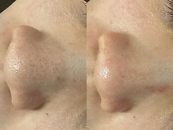 ケアナ 梅田店(CareNa)/ツヤ肌毛穴洗浄★ヒト由来幹細胞