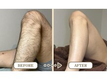 ビシルク(美 Silk)/アシ脱毛/静岡/草薙/清水区]