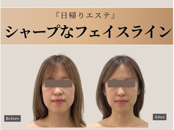 オーク ナチュリ 成城学園前(OAK×NACHUL)/口もとすっきり!きれいなVライン