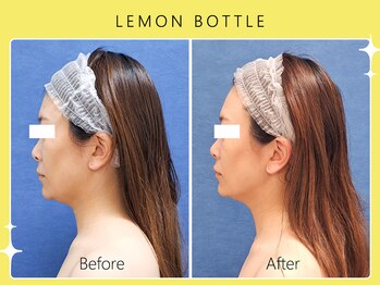 シロカネ 光の森店(SHIROKANE)/レモンボトル×小顔コルギ☆