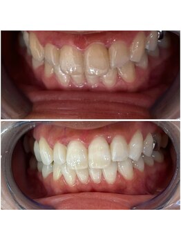 エクシアホワイトニング 代々木店/ホワイトニングビフォーアフター