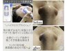 メンズNo.1【ハイドロスプラッシュ毛穴洗浄&乳酸ピーリング】毛穴&シミケア◎