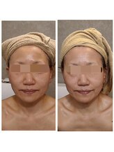 ウォーマル(warmaL)/小顔矯正