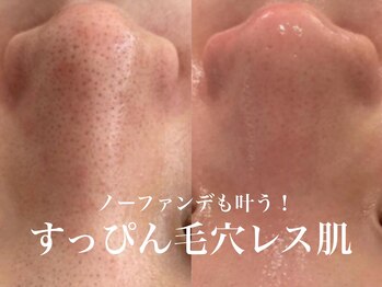 ルアナアイナ(Luana Aina)/ハーブピーリングで毛穴ケア