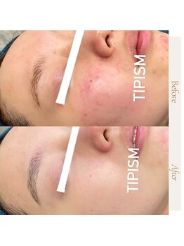 ノヴェイル(NoVeil)/Before/After