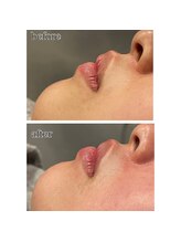 アデル 久留米(ADEL)/口周りの産毛脱毛