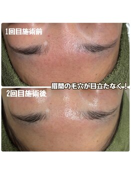 クラリ(Clari)/ハイドラ毛穴洗浄/毛穴ケア