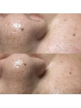 ラニー アンド ココネイル(LANIE&CocoNail)/毛穴ケア×Lit