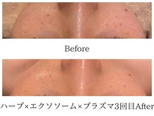 ラ セルフィー(Ra Selfee)/ハーブ×プラズマ×エクソソーム