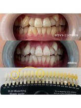 ホワイトニングビューティー 行橋店/4来店で7トーンアップ