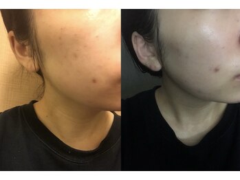 リリー(LILLY)/ダウンタイム