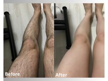 アップパイン(UPPINE)/全身脱毛/初回半額¥8,250