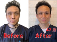 みき接骨院/美容鍼とニードルレスで変化　１