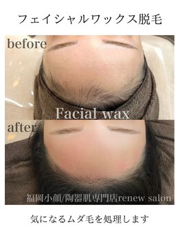 リニューサロン 本院(renew salon)/ツヤ肌☆フェイシャルワックス