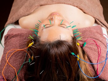 なかま鍼灸整骨院の写真/たるみ改善に◎顔の筋肉にアプローチし美容鍼でリフトアップ☆ハーブピーリングでほうれい線・ニキビケア♪