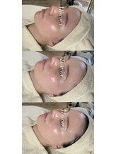 ミーミドットアイ(Mi-mi.i)/炭酸パックは絶対つけて！